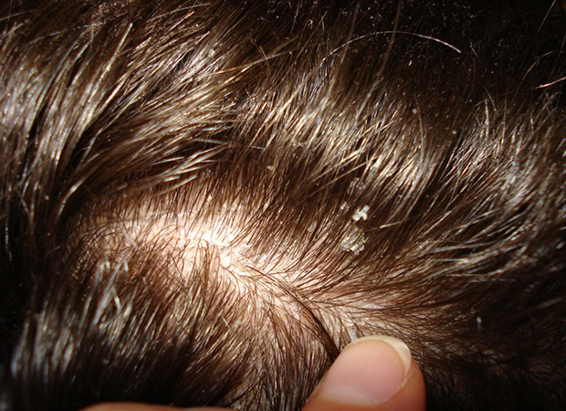 Основные причины появления себореи кожи головы