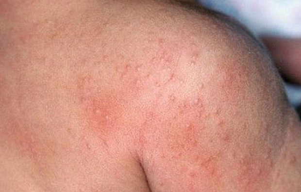 Лечение и профилактика себорейного дерматита на теле