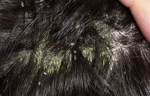 Лечение жирной себореи волосистой части головы