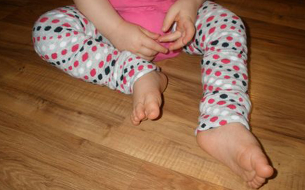 mikoz na noge palce stope u detej 4