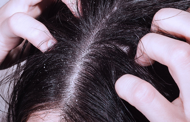 Особенности диагностики и лечения себореи кожи головы