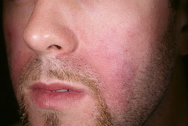 Причины, лечение себорейного дерматита сухого типа на лице
