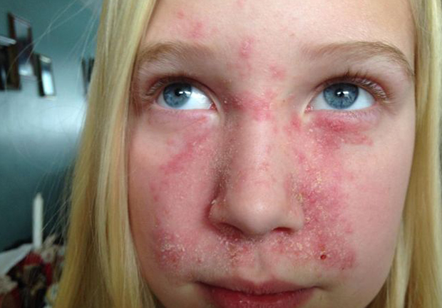 Внешний вид дерматита на лице