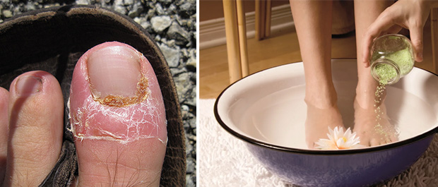 Ванночка для ног от грибка: приготовление в домашних условия с уксусом