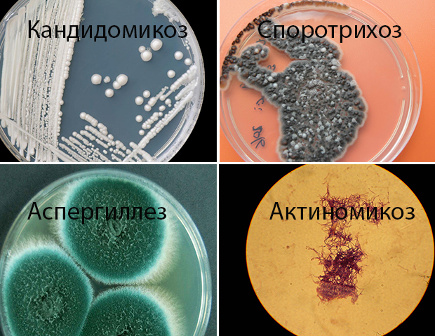 Разновидности грибковой инфекции