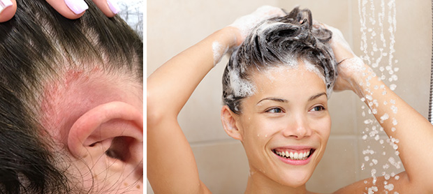 Мытье волос при себорее 