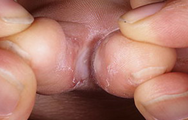 Грибок на пальцах ног: причины появления лечение и профилактика