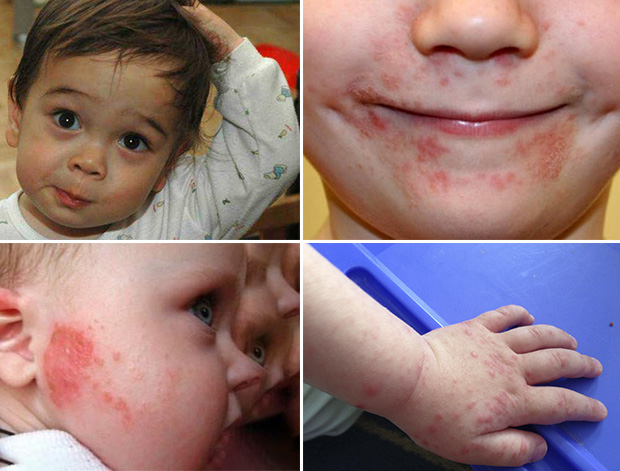 Себорейный дерматит у детей