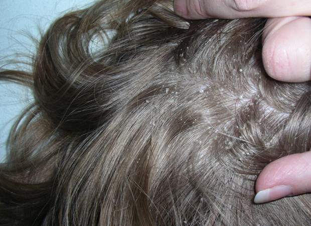Себорейный дерматит кожи головы сухого типа