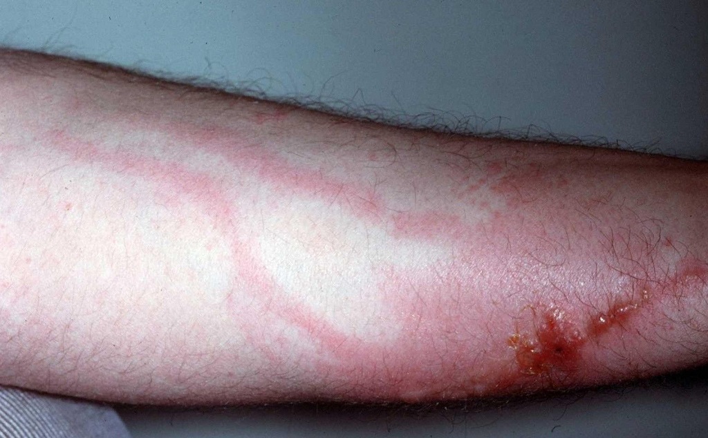 Gribkovyj dermatit lechenie